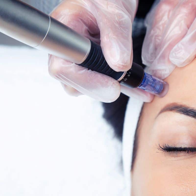 Morpheus8 treatment Sevenoaks from Lipo Sculpt - Book in today!