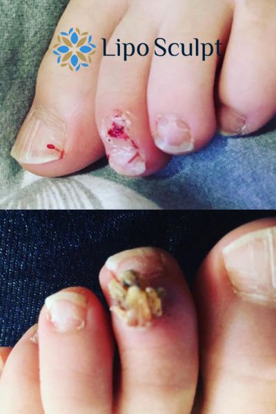 Wart removal customer results from Lipo Sculpt Sevenoaks
